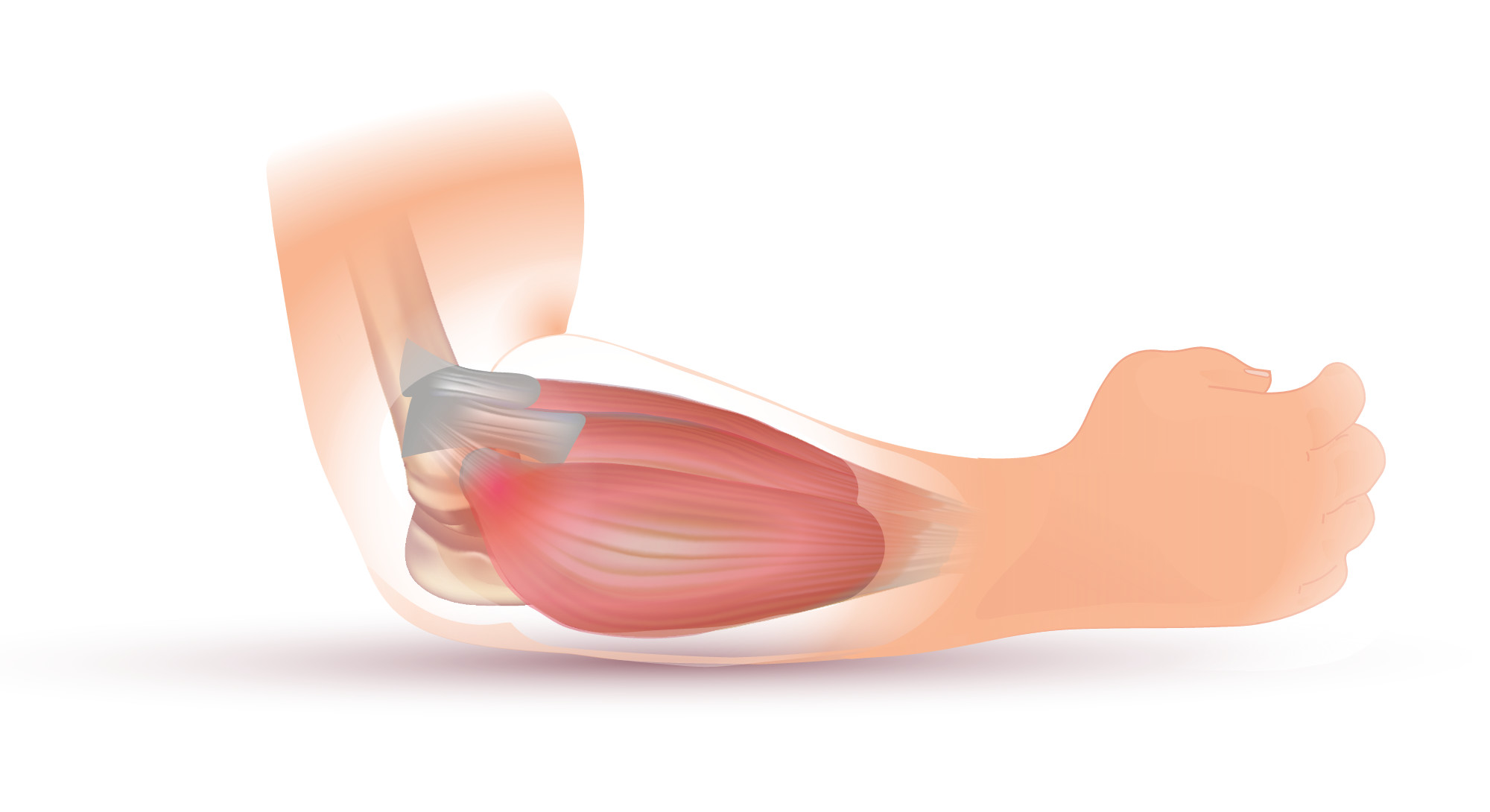 Tennis Elbow Illustration